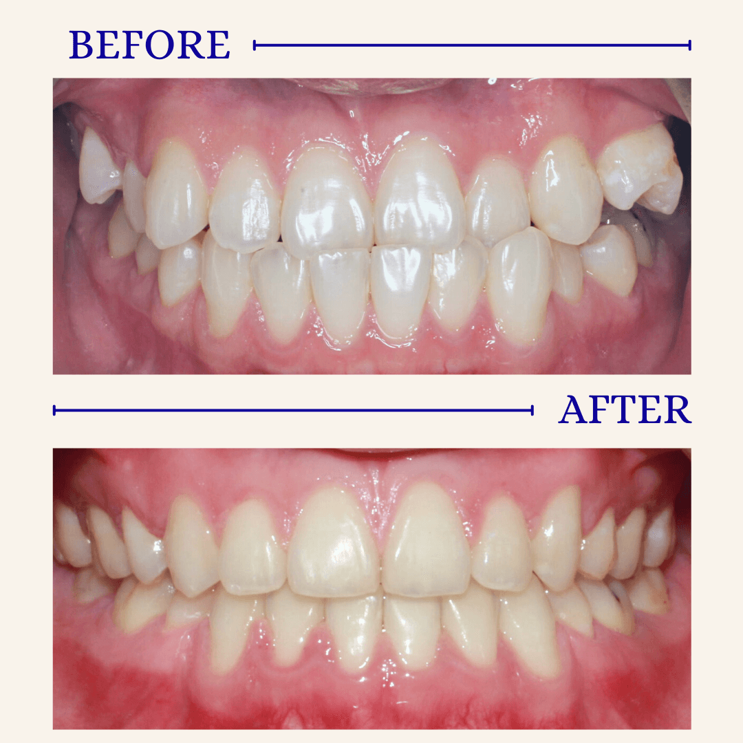 Before and After of a real patient's smile 